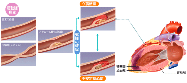 狭心症のメカニズム