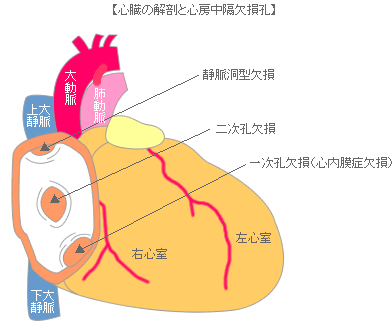 心房中隔欠損症