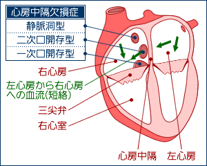 心房中隔欠損症２