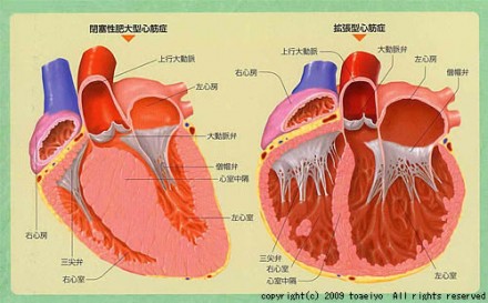 心筋症