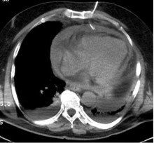 pericarditis/CT