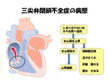 TR病態生理